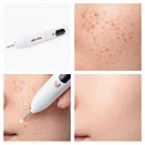 Plazmové pero na odstránenie bradavíc, pieh a kožných nedokonalostí