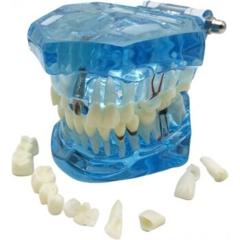 Model chrupu, zubných implantátov