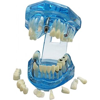 Model chrupu, zubných implantátov