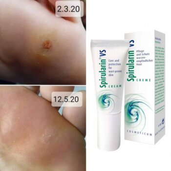 Spirularin VS – Ochranný krém na bradavice s patentovanou zložkou Spiralin® 10 ml
