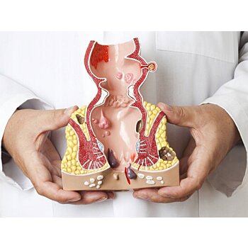 Prierezový model konečníka, hemeroidy (zväčšený) s patológiami