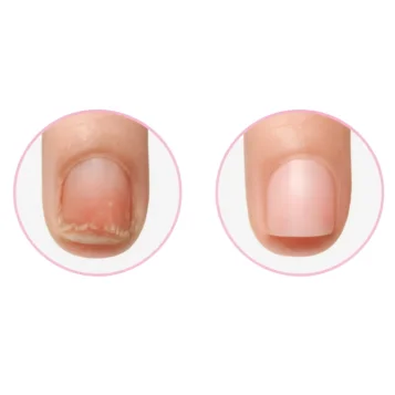 Akileine PRO krém na regeneráciu a obnovu nechtov s keratínom – 10 ml - Náhľad