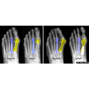 Dlaha na korekciu vykriveného palca, výrastkov a pľuzgierov halux - biela 2ks - Náhľad