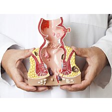 Prierezový model konečníka, hemeroidy (zväčšený) s patológiami