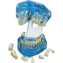 Model chrupu, zubných implantátov